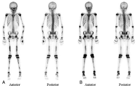 Bone Scintigraphy Images Of Patient 4 A Symmetric And Diffuse