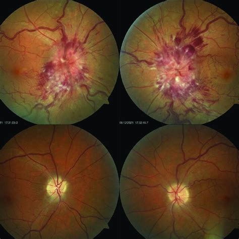 Optic Disk Photographs And Presentation Showing Severe Hemorrhagic