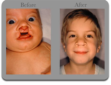 Cleft Palate Pictures