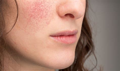 √ Eczema Types On Face 613188 Eczema Types On Face