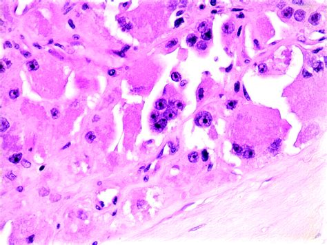 Alveolar Soft Part Sarcoma A Review And Update Journal Of Clinical