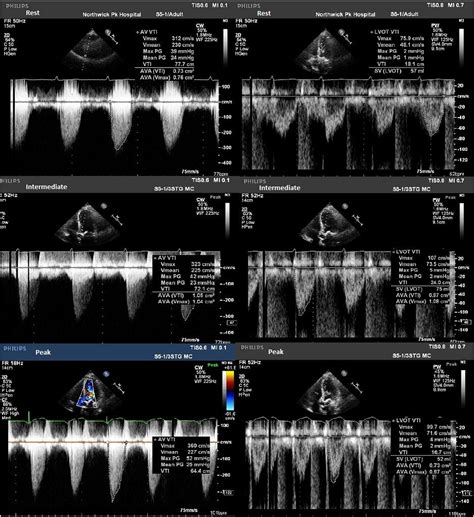 Dobutamine Stress Echo For Suspected Paradoxical Low Flow Low Gradient Severe Aortic Stenosis