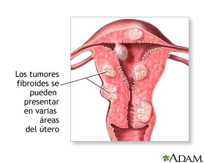 Miomas uterinos MedlinePlus enciclopedia médica