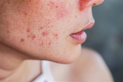 Acne And Acne Scarring The Kent Aesthetics Clinic