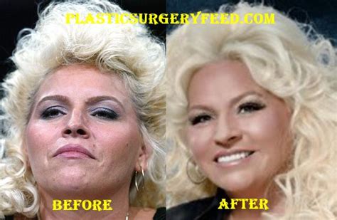 Beth Chapman Plastic Surgery Plastic Surgery Feed