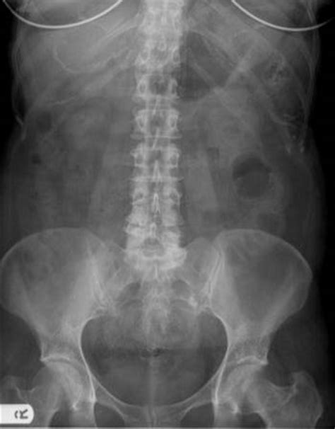 Bowel appearance (presence and absence of gas and feces, and the location of bowel loops) is extremely variable. Abdominal_Radiology_Quiz