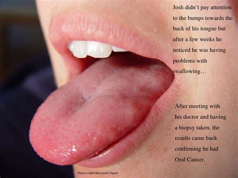 A canker sore looks like an ulcer, usually with a depression in the center. Oral cancer