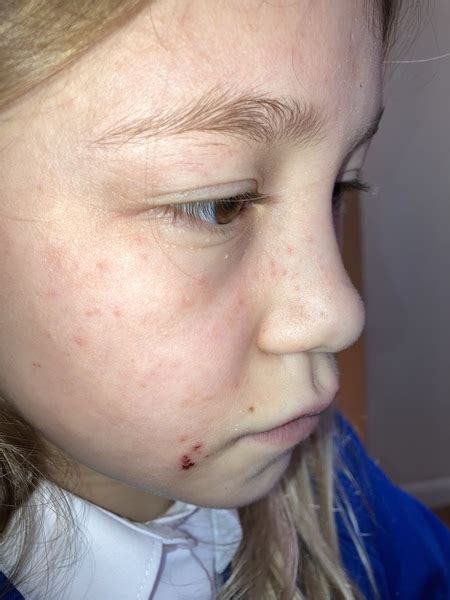Red Spots On Dds Face Eczema Mumsnet