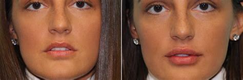 Lip Augmentation Before And After Photos Page 6 Of 6 Plastic