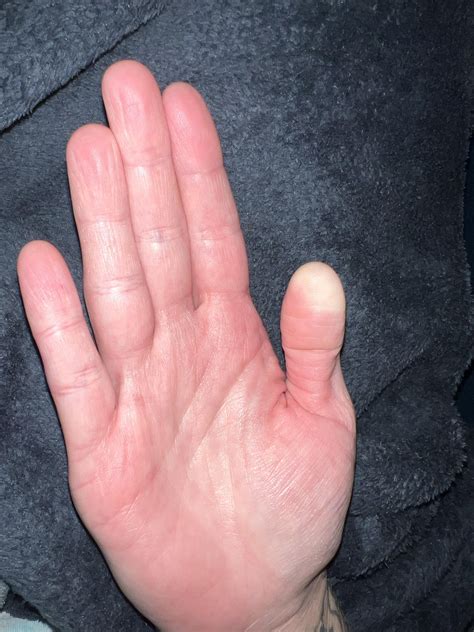 Why do I always get the ET fingers 😂 : r/Raynauds