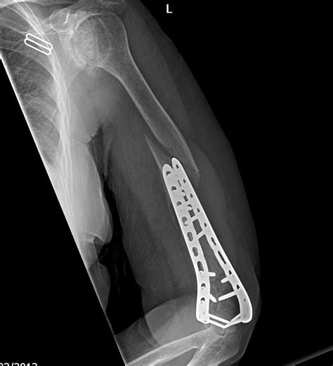 Comminuted Distal Humerus Fracture Ao Type C3 In An Elderly Patient