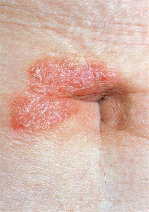 Psoriasis Affecting The Navel Umbilicus Photograph By Dr Hcrobinson