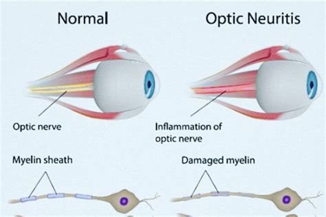 Symptoms Causes Treatments Of Optic Neuritis The Eye News