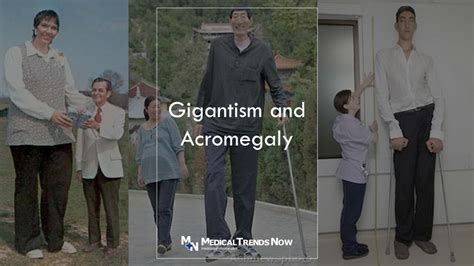 warning signs of gigantism and acromegaly what to do if you notice them medical trends now