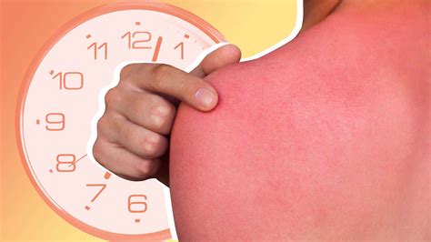 How Long Does A Sunburn Last Experts Explain