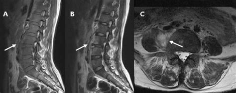 A 38 Year Old Woman Paravertebral And Psoas Abscess Type A And B