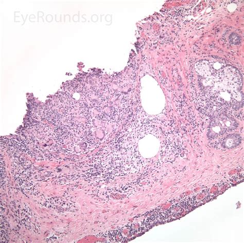 Benign Lesions Of The External Periocular Tissues