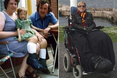 Woman With Tree Trunk Legs Weighing 4 Stone Each Desperate For Surgery To Remove The Fat