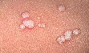 Plantar warts are viruses that you get when you've contracted the hpv virus from a contaminated surface, says dr. Types Of Warts And Treatment - Moles, Warts & Skin Tags ...