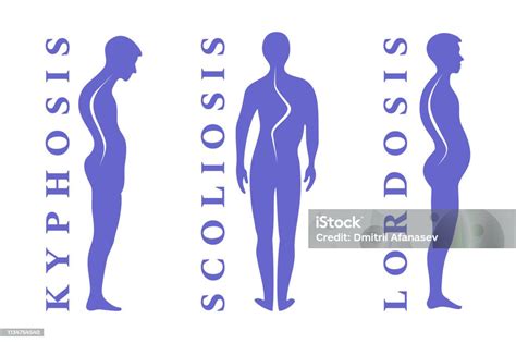 Diseases Of The Spine Scoliosis Lordosis Kyphosis Body Posture Defect