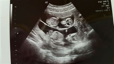 Fraternal Twin Ultrasound Twin Ultrasound Baby