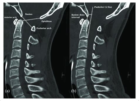 Cervical Spine CT Scan With Normal Findings A Power S Ratio And B Download Scientific