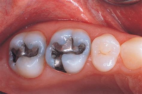 Amalgam Fillings Are They Bad For Me Dental At Keys