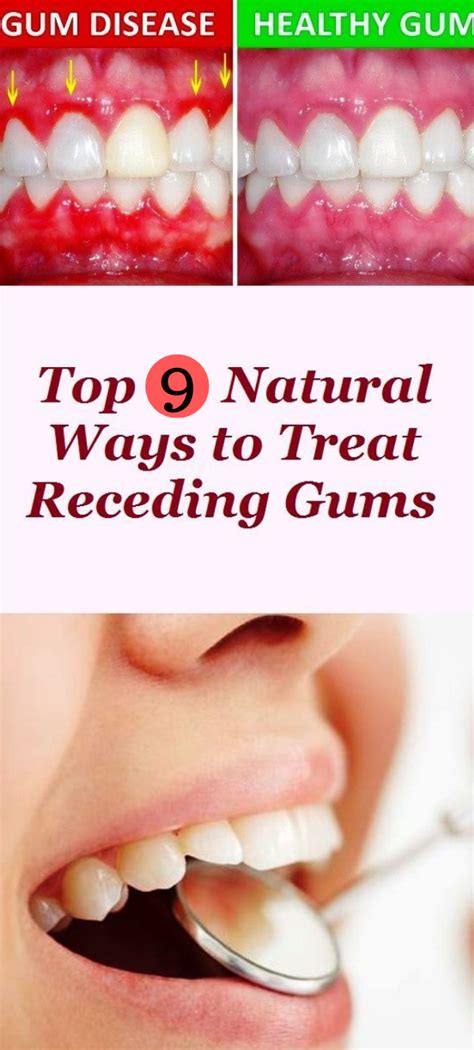 How To Reverse Gum Disease Naturally How To Regrow Gums Between Teeth Obviously The Best