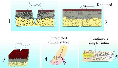 Surgical Suture Types Of Sutures Sizes How To Suture And Suture Removal Times