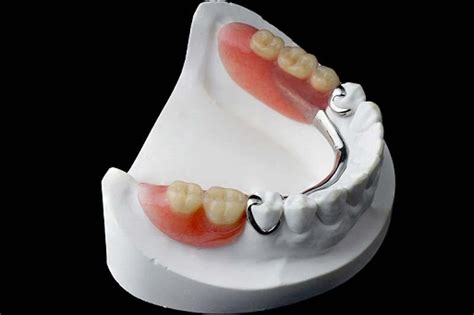 Partial Dentures A Viable Alternative To Dental Implants