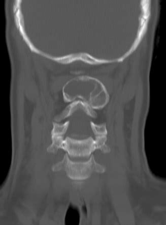 Aneurysmal Bone Cyst Cervical Spine Image Radiopaedia Org