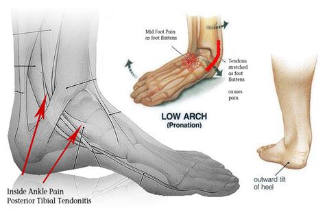 Diagnosis For Ankle Pain