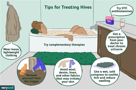 Hives Urticaria Treatment