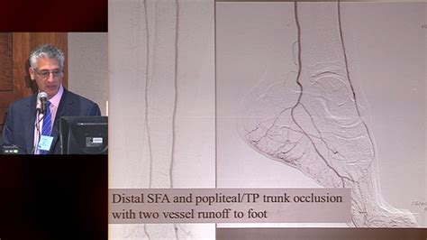 Video Anatomic Staging For Chronic Limb Threatening Ischemia Ucsf