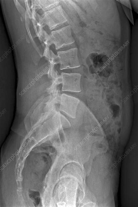 Picture Of X Ray Spontaneous Symptomatic Pseudoarthrosis At The L2 L3