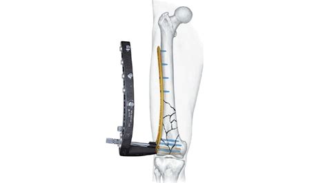 Lcp™ Distal Femur Plate Products Depuy Synthes