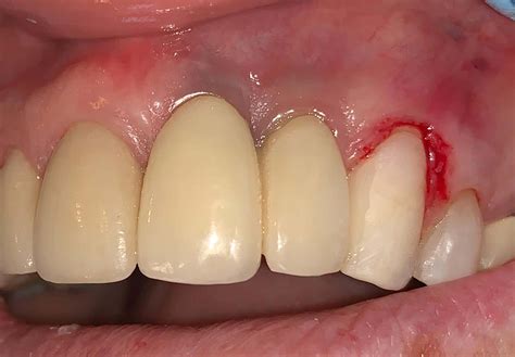 Zirconia Implants Metal Free Ceramic Teeth Replacement