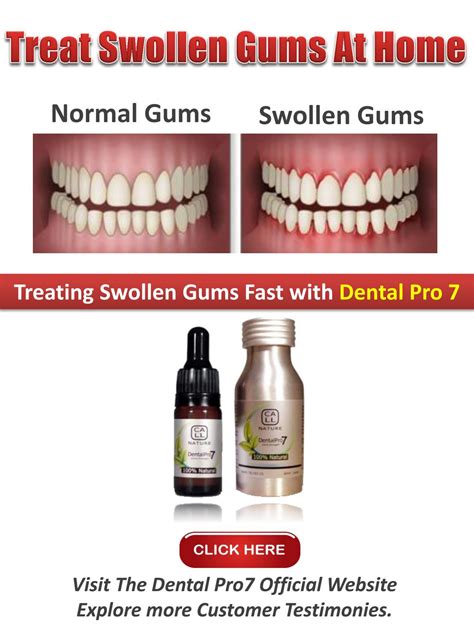 Swollen Gums Around One Tooth Home Remedy By Angela R Carlson Issuu