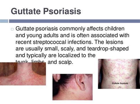 Psoriasis And Scabies By Manaswi