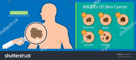 Skin Cancer Diagnosis Dermatology Screening Examination Stock Vector