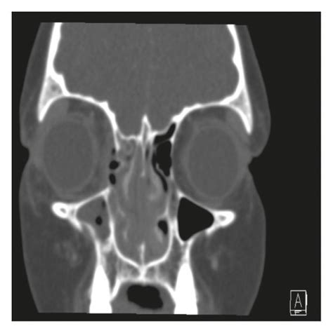 Computed Tomography With Contrast Images Of The Presented Case A