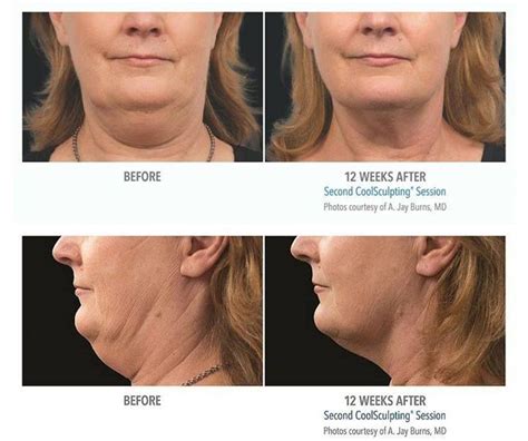 Coolsculpting For The Neck Its Here And It Works Call Now To Book Your Appointment