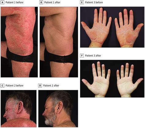Evaluation Of Ixekizumab Treatment For Patients With Pityriasis Rubra