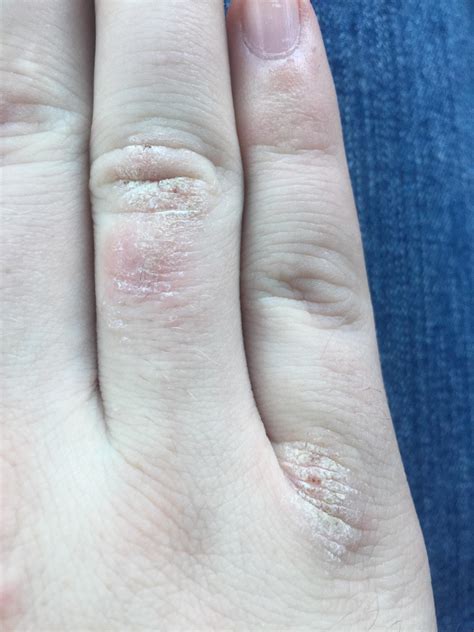 Skin Concern I Have Three Dry And Cracking Spots On My Right Hand