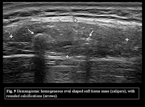 Figure 18 From Benign Lesions Of The Subcutaneous Soft Tissue With Calcifications Which Is The