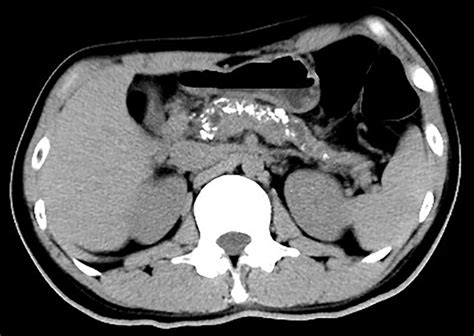 Abnormalities On Computed Tomography Of The Pancreas The Bmj