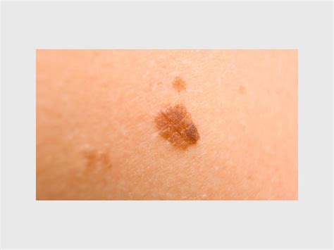 Skin Cancer Who Is At Risk And What Can Be Done Review
