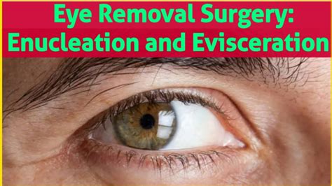 Enucleation And Evisceration Youtube
