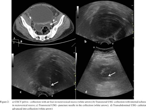 Ultrasound Guided Transrectal Catheter Drainage Of Pelvic Collections