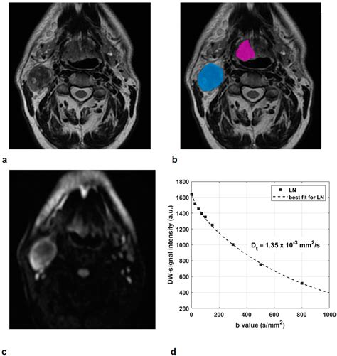 Jcm Free Full Text Multiparametric Mri Evaluation Of Oropharyngeal